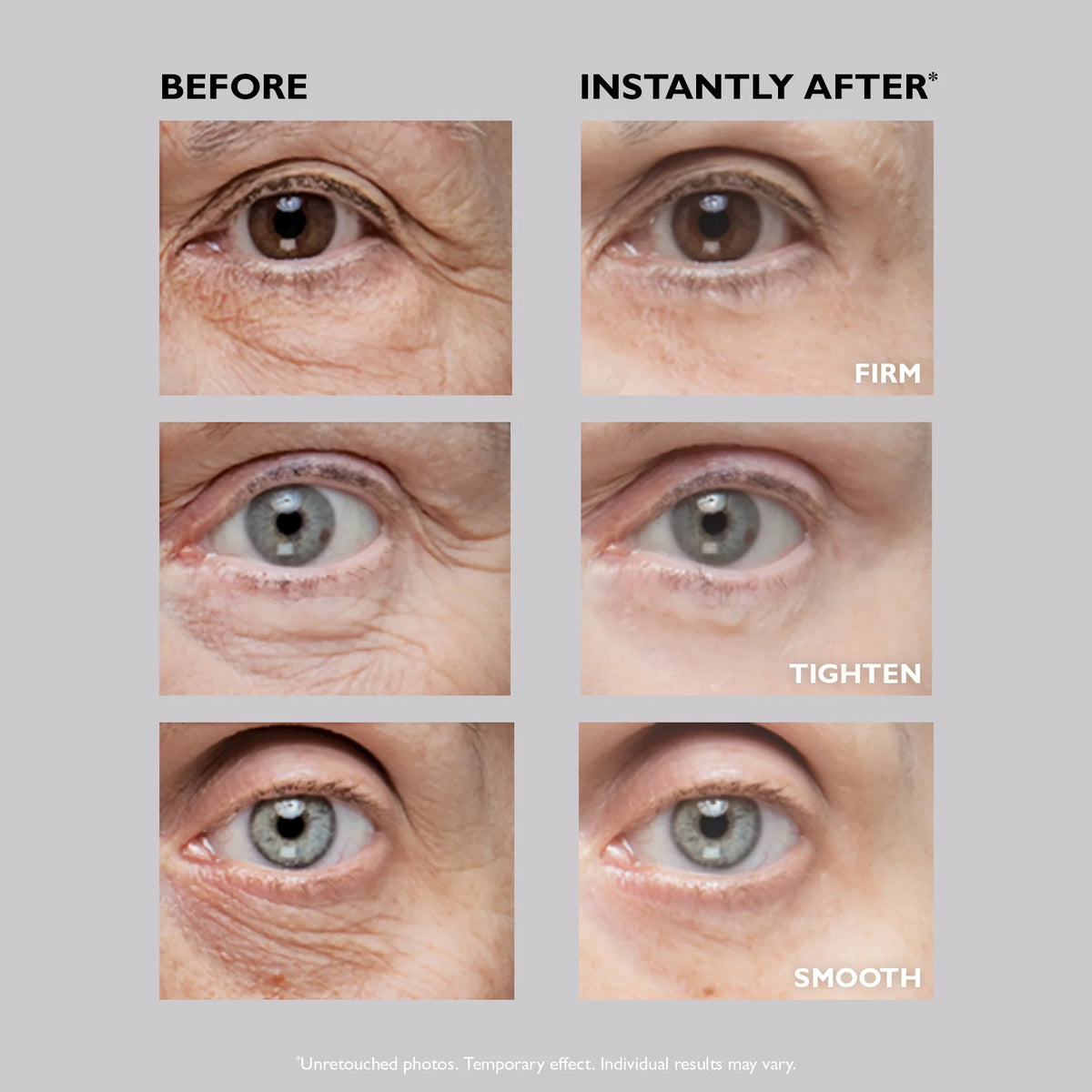 Clinical study before and after photo results grid showing dramatic eye puffiness reduction