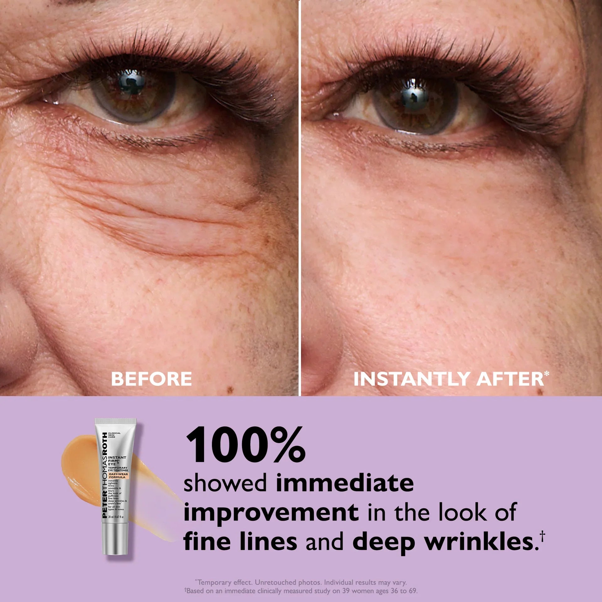 Immediate eye bags puffiness before and after results on female model Trini
