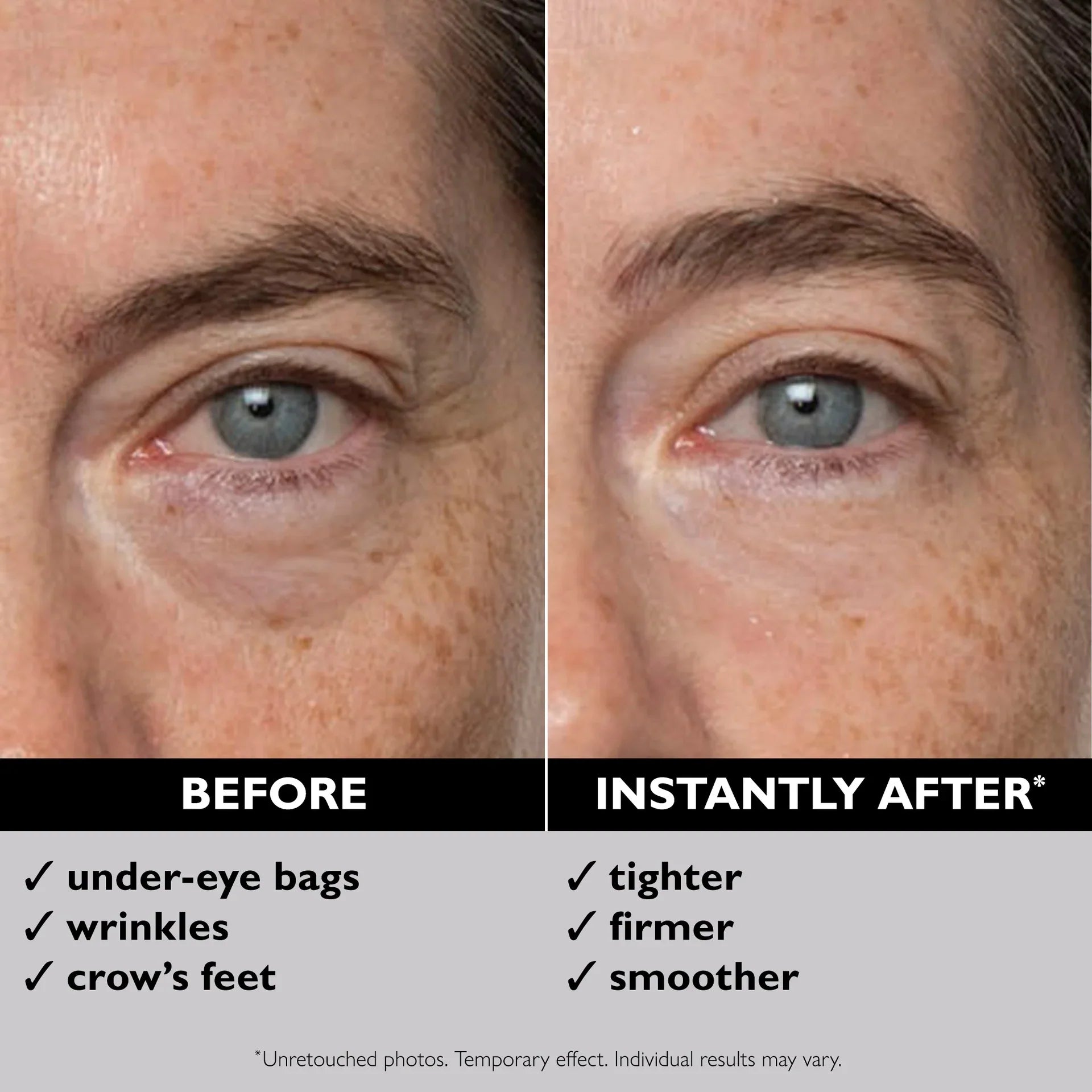 Immediate before and after comparison of under-eye wrinkles and crow's feet improvement