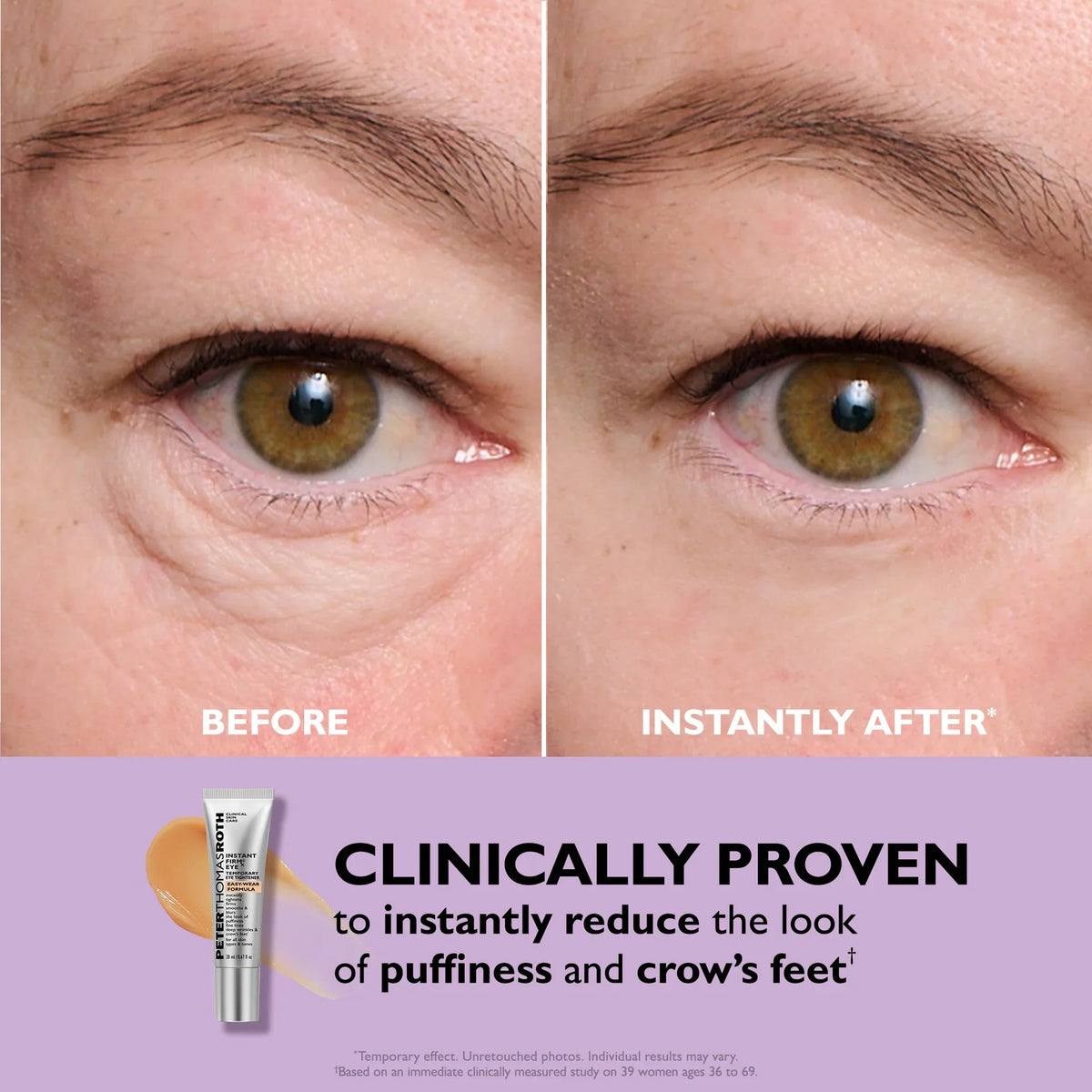 Under eye bags clinical before and after photo comparison on female model Heni