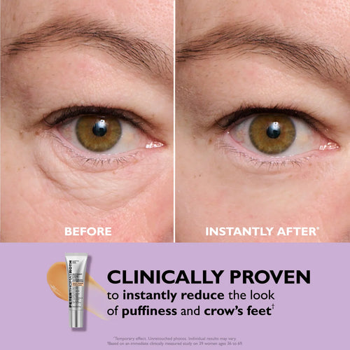 Under eye bags clinical before and after photo comparison on female model Heni